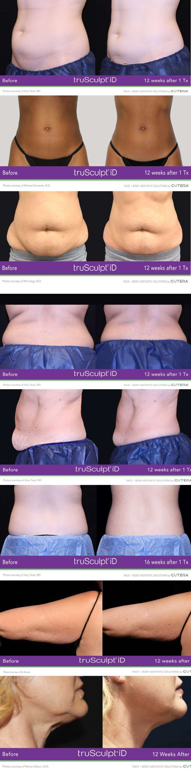 FAT-REDUCTION-before-after