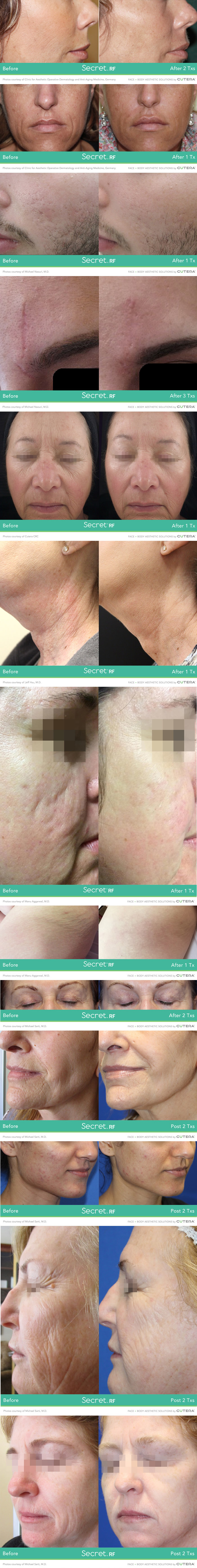SKIN TREATMENT Before and After